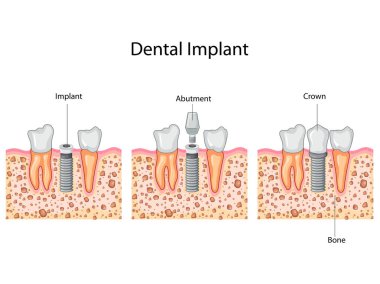 Eğitim grafik Dental Implant işlemi diyagramı