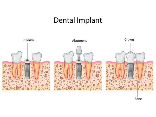 Schema didattico del processo implantare dentale Schema — Vettoriale Stock