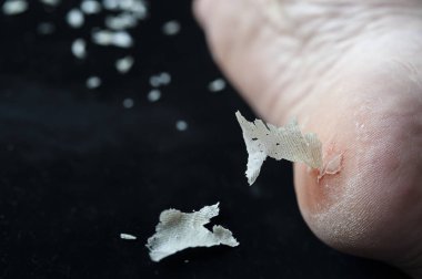 Kuru Cilt soyma kırık topuk, siyah arka plan, çekim makro lens