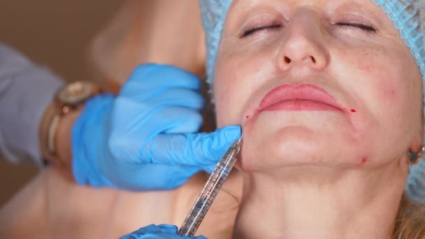 Cirurgião plástico remove rugas com toxina botulínica no rosto de uma mulher — Vídeo de Stock