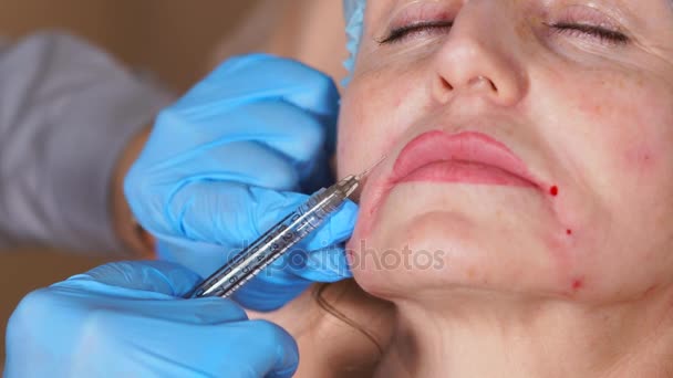 Close up shot of procedure of introducing Botox to smooth out facial wrinkles — Stock Video