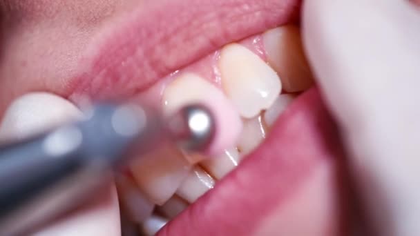 Полірування зубів в стоматологічному кабінеті — стокове відео