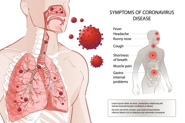 Симптоми MERS-Cov людини - фактори ризику. Поширення пандемії вірусу . — стоковий вектор