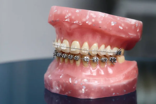 Modelo de mandíbula ou dentes humanos com aparelho dentário com fios metálicos — Fotografia de Stock