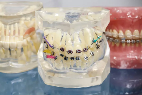 Modelo dental de ortodoncia de dientes humanos con implantes, frenos dentales — Foto de Stock
