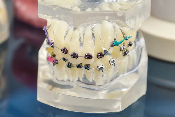 Ортодонтична стоматологічна модель зубів людини з імплантатами, зубні дужки — стокове фото