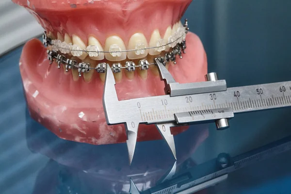 Modelo de mandíbula o dientes humanos con abrazaderas dentales con cable metálico — Foto de Stock