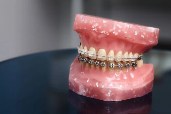 Modelo de mandíbula ou dentes humanos com aparelho dentário com fios metálicos — Fotografia de Stock