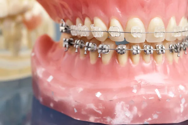 Modelo de mandíbula ou dentes humanos com aparelho dentário com fios metálicos — Fotografia de Stock