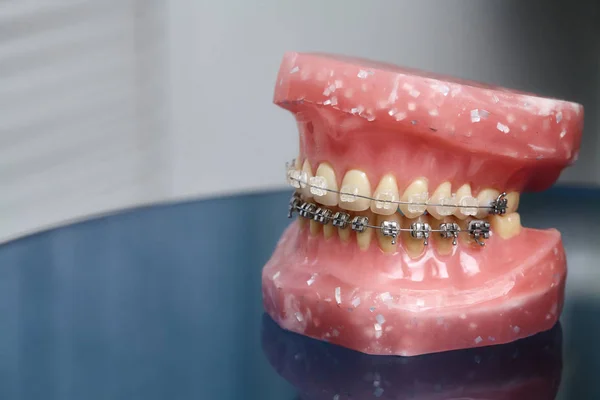 Modelo de mandíbula ou dentes humanos com aparelho dentário com fios metálicos — Fotografia de Stock