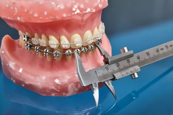 Menselijke kaak of tanden model met metalen wired tandheelkundige bretels — Stockfoto