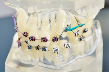 İnsan çene veya dişleri ortodontik diş modeli ile implantlar, diş diş telleri