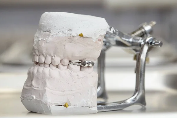 Molde dental gris de dientes de prótesis, modelo de encías humanas de arcilla — Foto de Stock