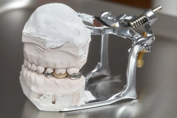 Molde dental gris de dientes de prótesis, modelo de encías humanas de arcilla — Foto de Stock