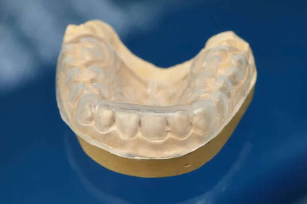 Prótesis dental molde de dientes, modelo de encías humanas de arcilla — Foto de Stock