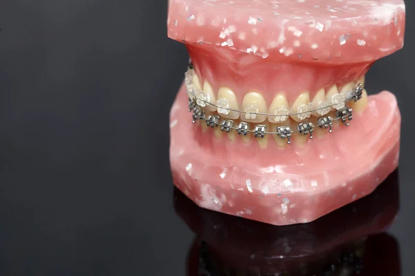 Modelo de mandíbula ou dentes humanos com aparelho dentário com fios metálicos — Fotografia de Stock