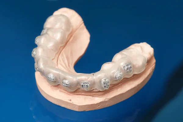 Modelo de mandíbula o dientes humanos con abrazaderas dentales con cable metálico — Foto de Stock