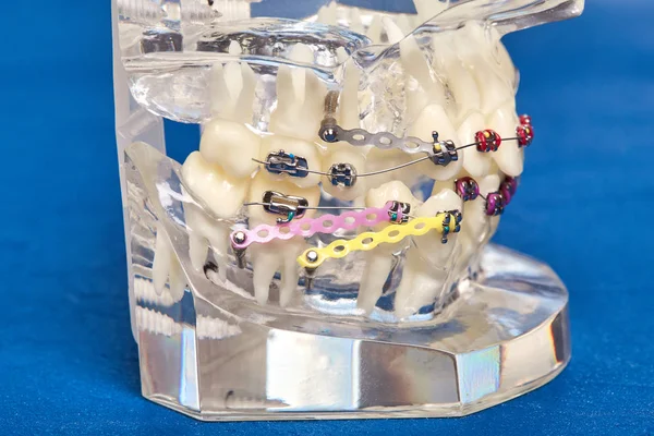 Modelo dental de ortodoncia de dientes humanos con implantes, frenos dentales — Foto de Stock