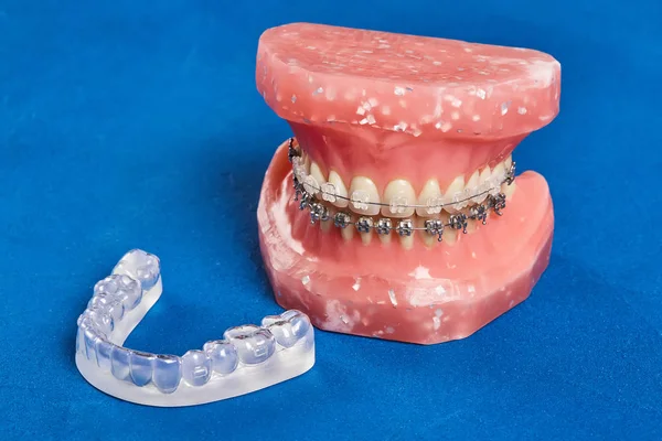 Modelo de mandíbula ou dentes humanos com aparelho dentário com fios metálicos — Fotografia de Stock