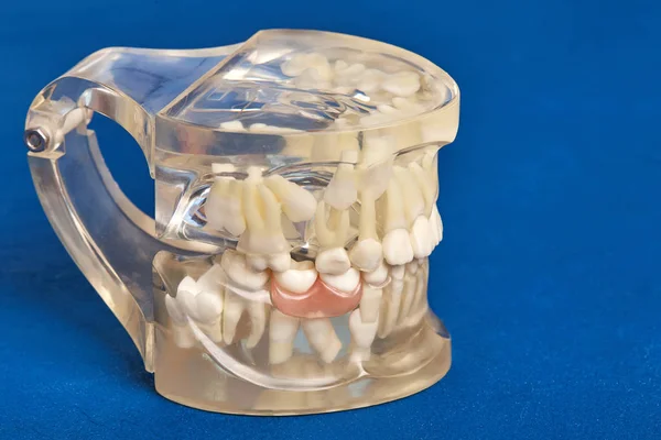 Human teeth orthodontic dental model with implants, dental braces — Stock Photo, Image