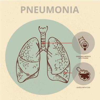Akciğerlerinde zatürree belirtileri olan bir kişinin şematik görüntüsü..