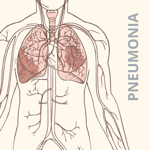 Um vetor esquemático ilustração do corpo humano com órgãos internos e uma imagem de pneumonia dos pulmões — Vetor de Stock