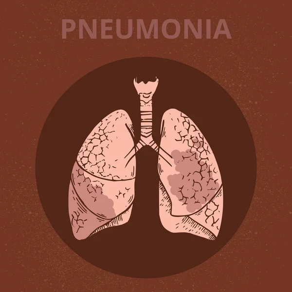 Az emberi test vázlatos illusztrációja a coronavirus covid tüneteinek infografikájával 19. — Stock Vector