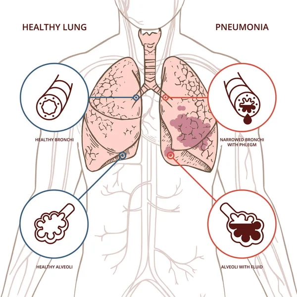Una ilustración esquemática del cuerpo humano con una infografía de los síntomas del coronavirus covid 19 . — Archivo Imágenes Vectoriales