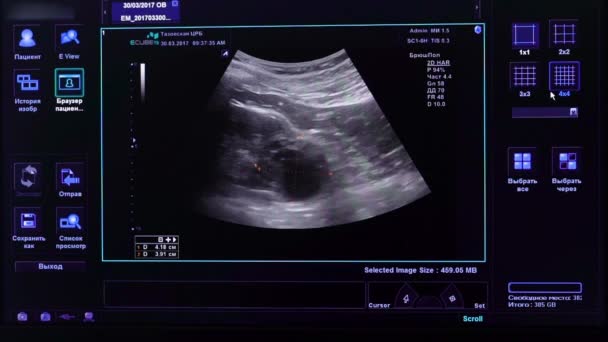 Image sur le moniteur d'une machine à ultrasons médicale . — Video