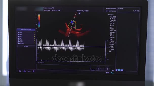 Bir tıbbi ultrason makinesi monitörde görüntü. — Stok video