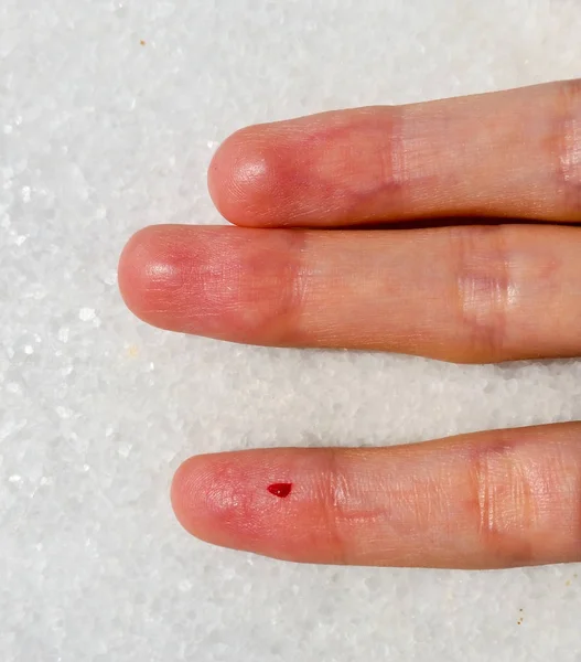 Primer plano del dedo femenino con gota de sangre para análisis de sangre —  Fotos de Stock