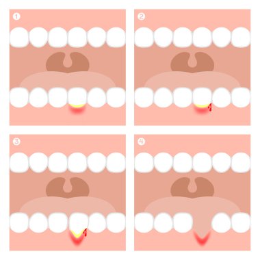 Dişeti iltihabı veya Periodontitis illüstrasyon vektör Infographic
