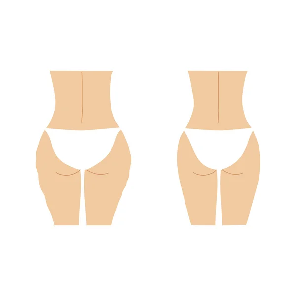 Fond femme avec cellulite avant et après . — Image vectorielle