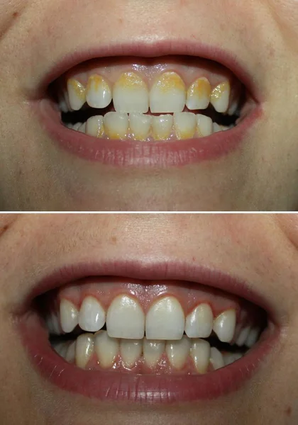 Реал Після Видалення Зубного Каменю Нальоту Жовтий Зубного Каменю Стоматологічна Ліцензійні Стокові Зображення