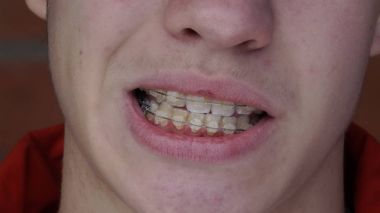 Diş telleri olan genç bir adam