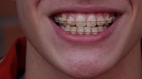 A young man with braces — Stock Photo, Image