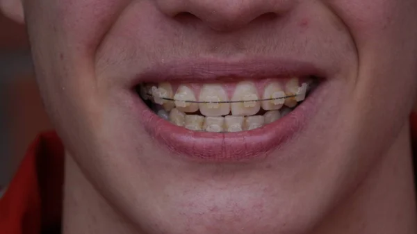 Diş telleri olan genç bir adam — Stok fotoğraf
