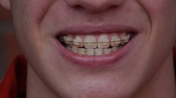 A young man with braces — Stock Photo, Image