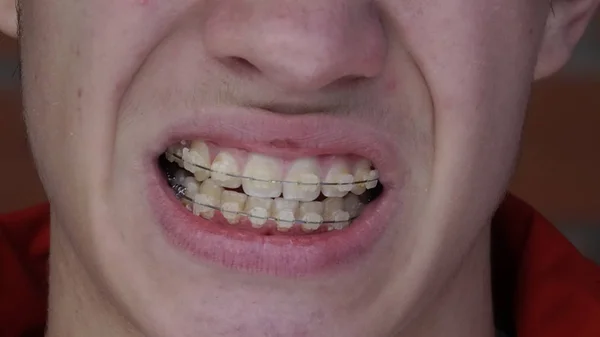 A young man with braces — Stock Photo, Image