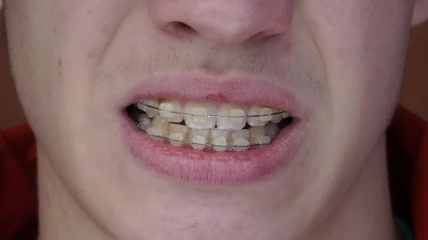 A young man with braces — Stock Photo, Image