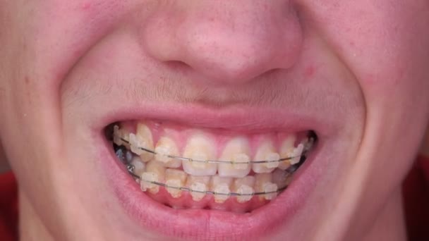 一个戴着牙套的年轻人微笑，大笑 — 图库视频影像