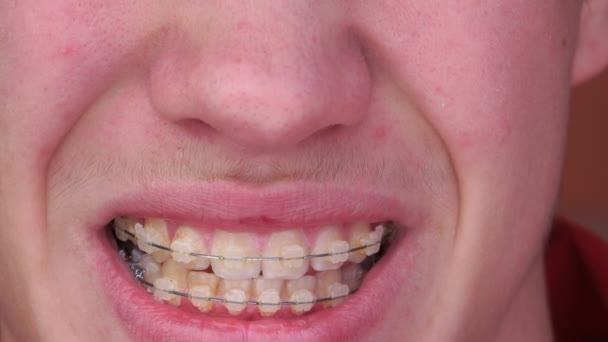 Un joven con aparato ortopédico Sonriendo, riendo — Vídeo de stock