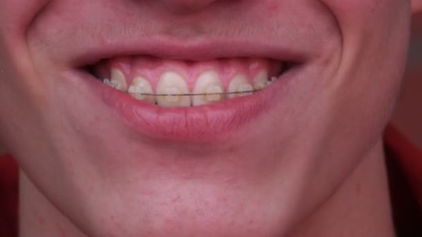 Diş telleri olan genç bir adam gülüyor, gülüyor — Stok video