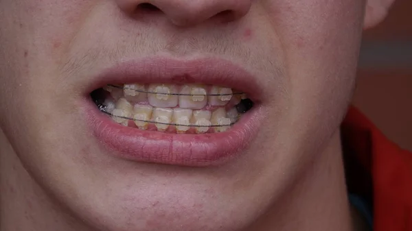 Un joven con aparato ortopédico Sonriendo, riendo — Foto de Stock