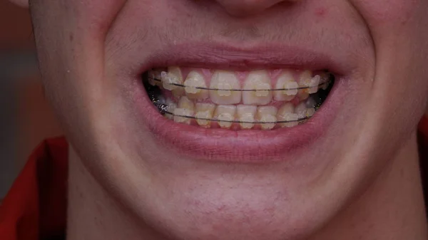 Un joven con aparato ortopédico Sonriendo, riendo — Foto de Stock