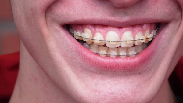 Un joven con aparato ortopédico Sonriendo, riendo — Foto de Stock