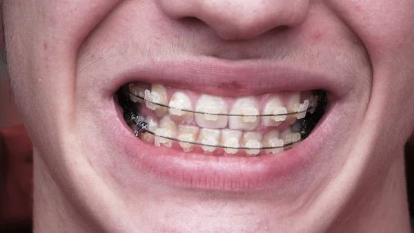 A young man with braces Stock Photo