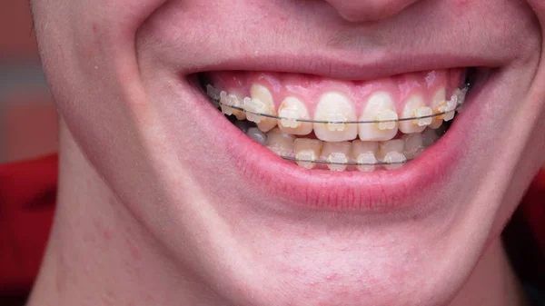 A young man with braces Smiling, laughing Royalty Free Stock Images