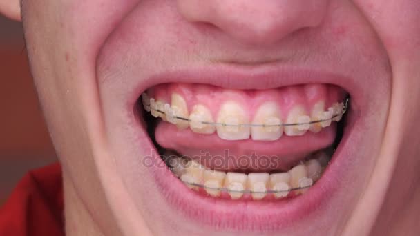 一个戴着牙套的年轻人微笑，大笑 — 图库视频影像