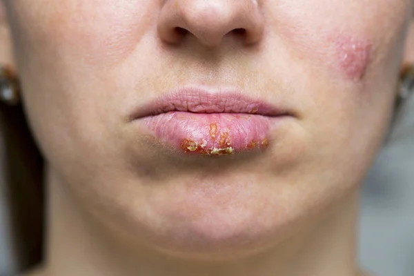 Closeup of a common cold sore virus herpes. Part of a young woman\'s face with a virus herpes on lips